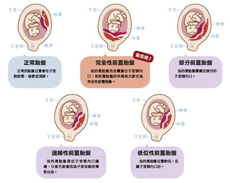 前置胎盤剝離|了解胎盤早期剝離原因，預防早期胎盤剝離風險，13大。